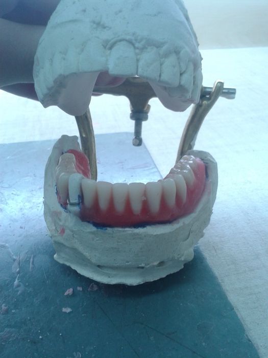 Продам протезы съёмные