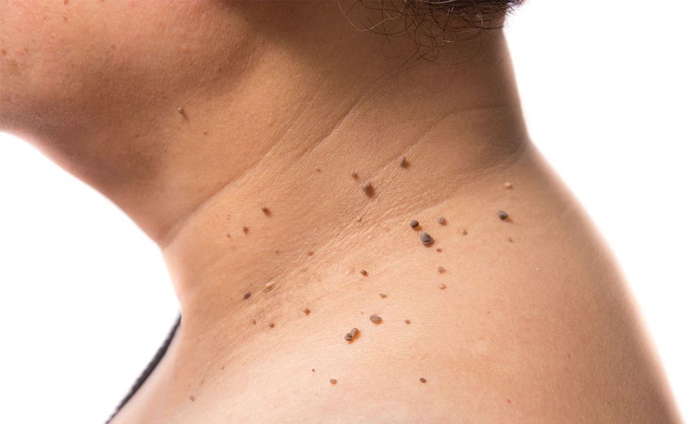 Crema pentru eliminarea papiloamelor