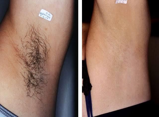 Шугаринг  На выезд