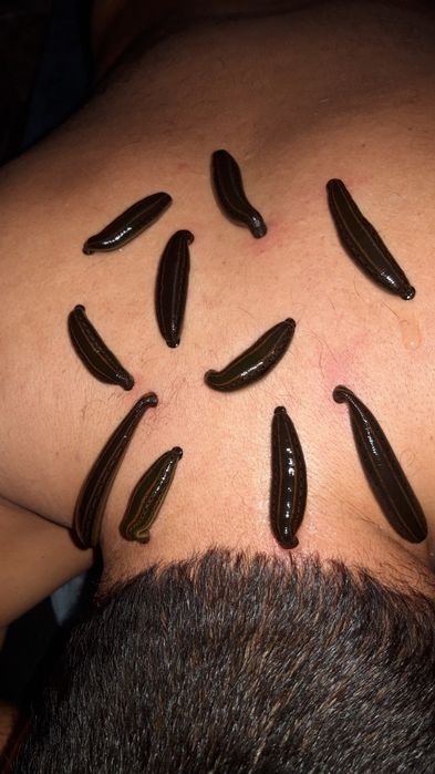 Хиджама. Шертпе. Пиявки