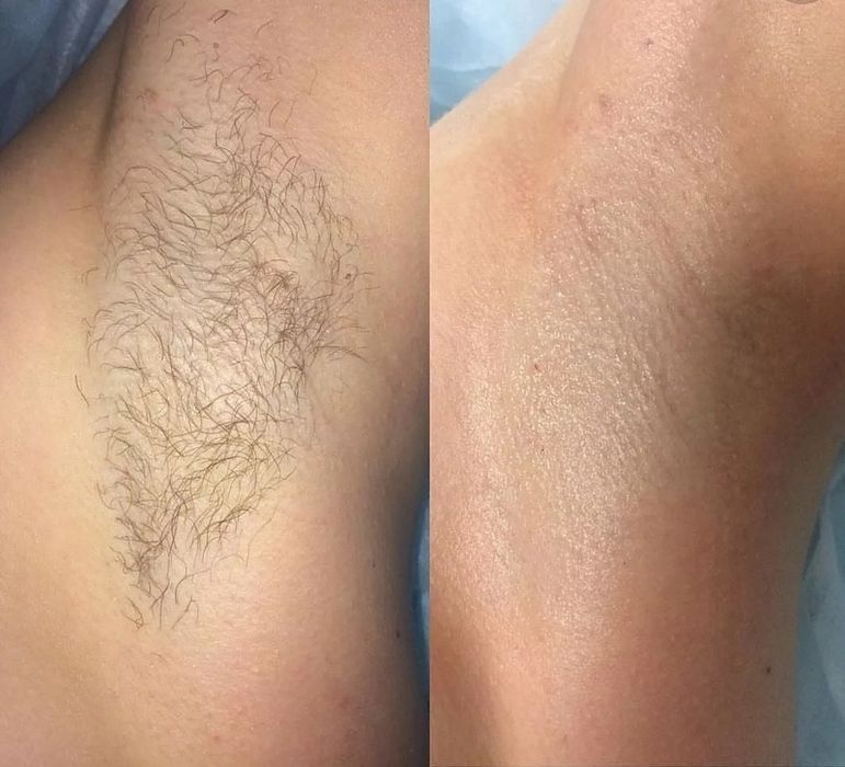 Лазерная эпилация в Самарканде