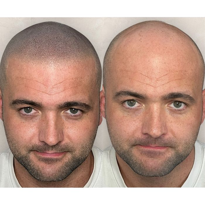 Micropigmentare Scalp și barba Bucuresti SMP chelie implant transplant