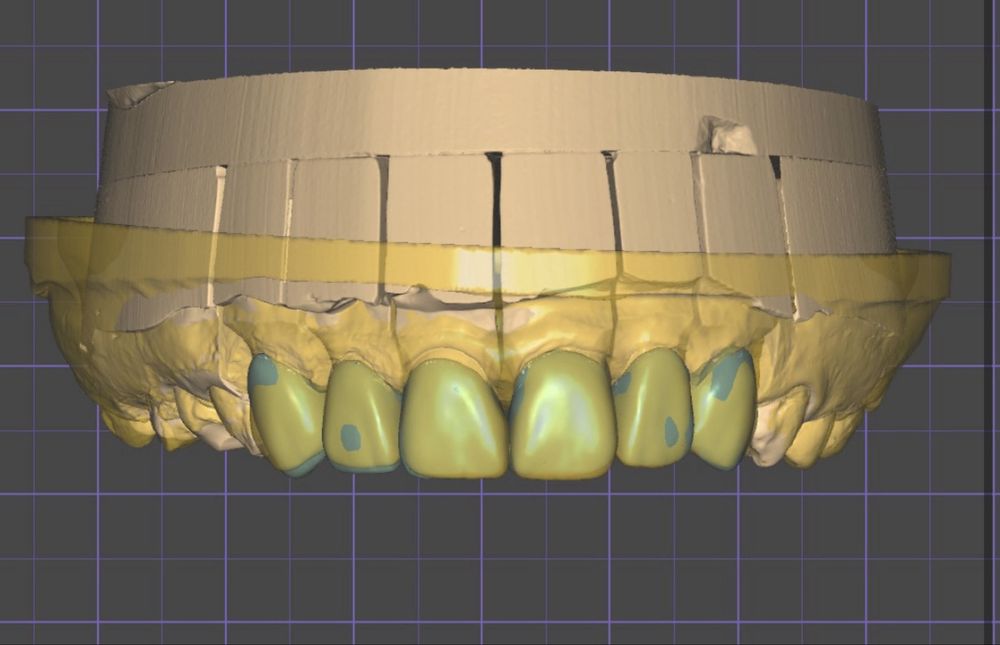 Импланты от 49.999