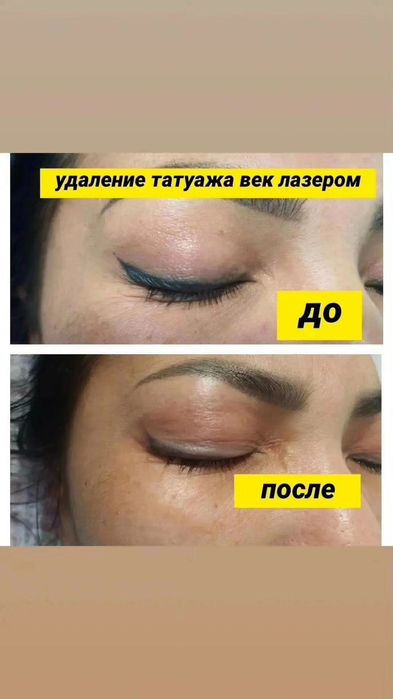 Удаление татуажа лазером 5000т