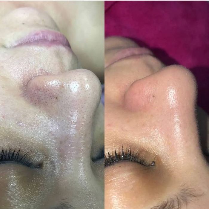 Косметолог для женщин чистка лица пиллинг возможно выезд м. Шахристон