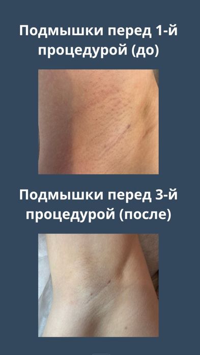 Лазерная эпиляция