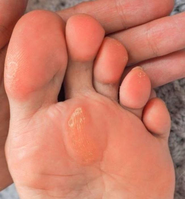 Квалифицированная помощь подолога.