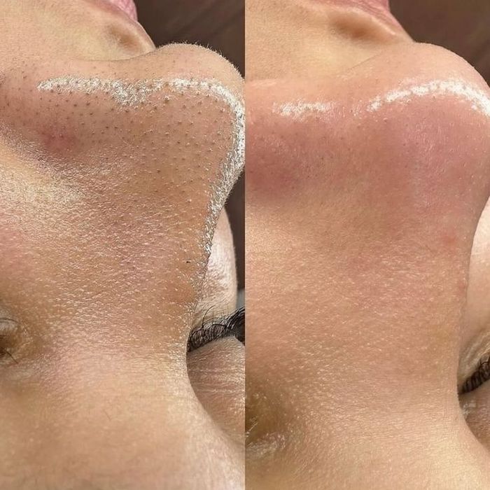 Epilat ceara si tratamente faciale