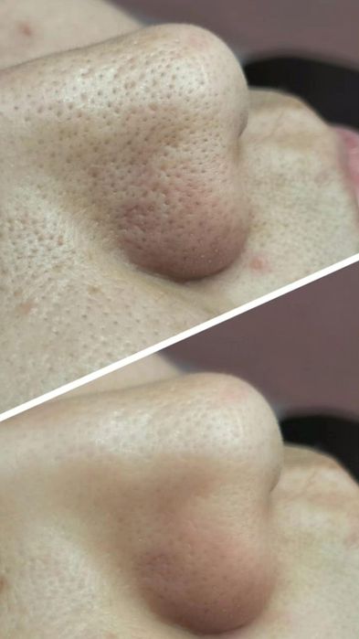 Чистка лица АКЦИЯ