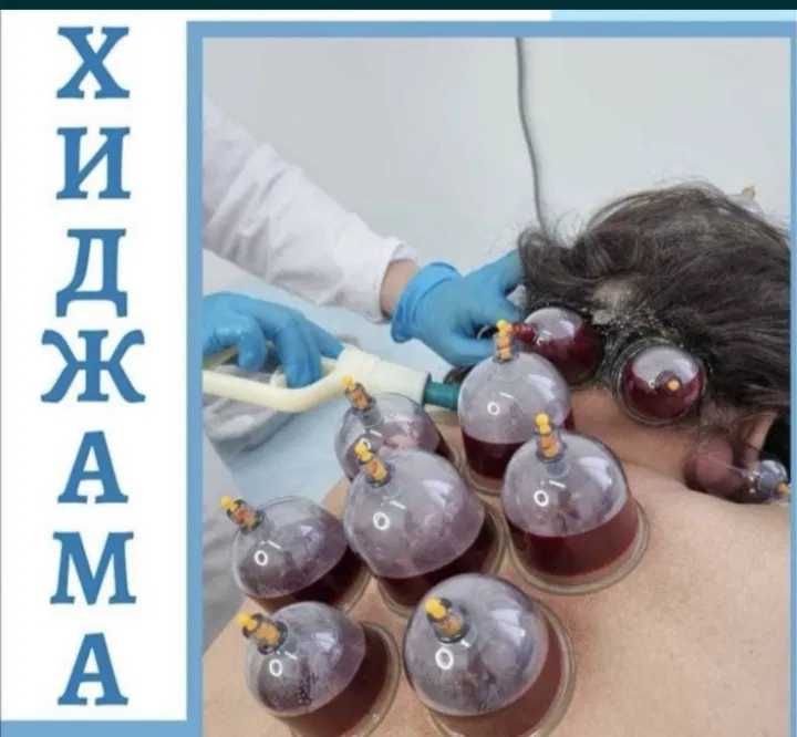 Шертпе. Хиджама. Кровопускание