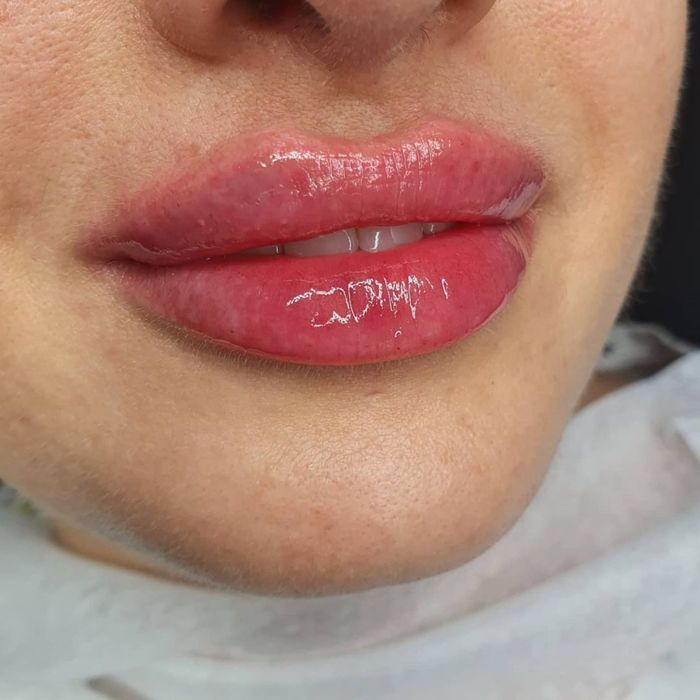 Увелечение губ 700000 ,а так же на все процедуры скидки