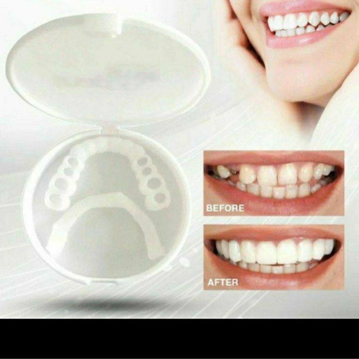 виниры для зубов