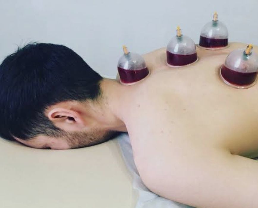 Хиджама сухой хиджама пиявки zuluk