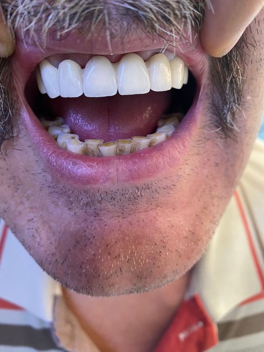 Протезы ,Циркон, Керамика , Виниры!