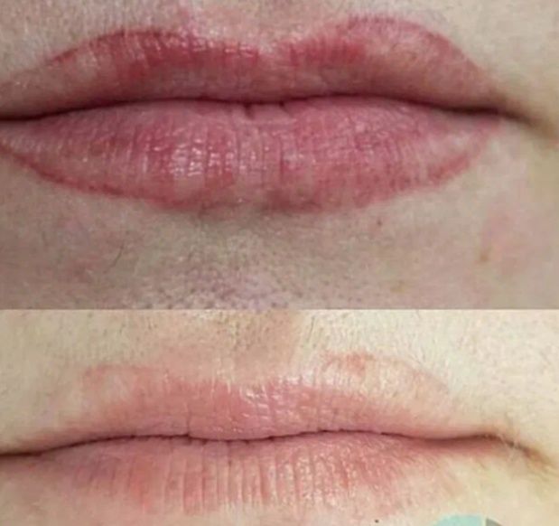 Удаление лазером тату от 5000