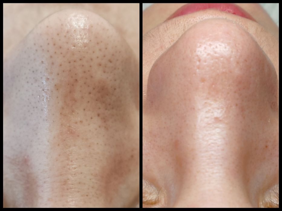 DOAR FEMEI!!! Epilat FEMEI cu ceara de unica folosința,Ep. Definitiva