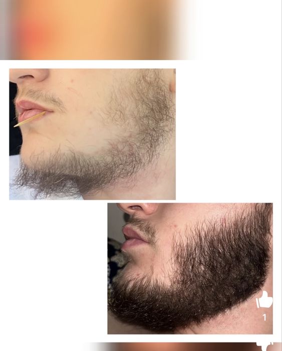 Soch va soqol o'stiradigan losyon