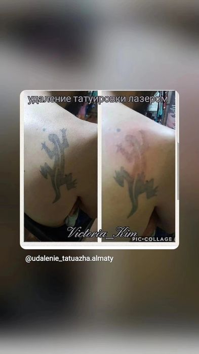 Удаление татуажа лазером 5000т