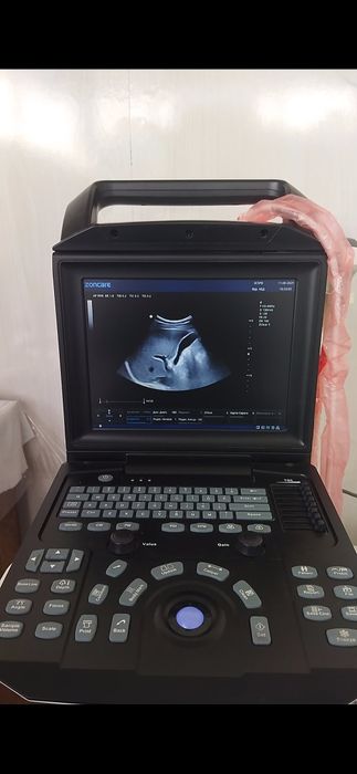 УЗИ аппарат портатив