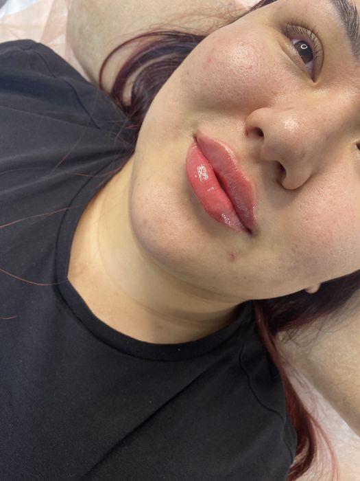 Акция Увеличение Губ