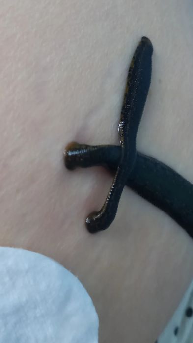 Лечение пиявками Сулikпен емдеу