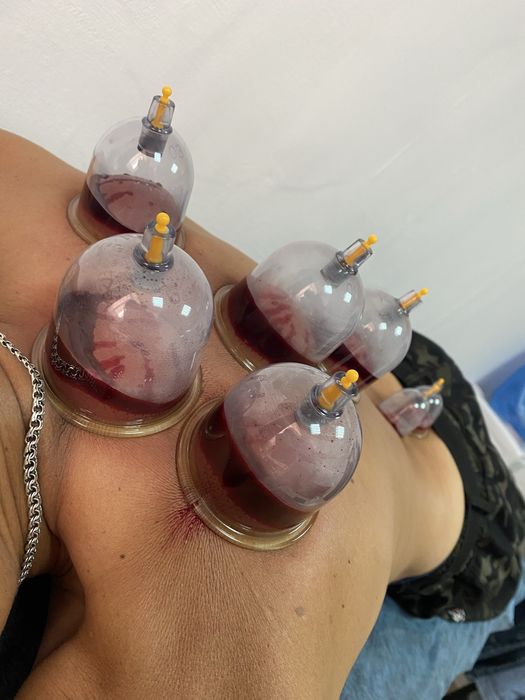 Хиджама лечнбно оздоровление