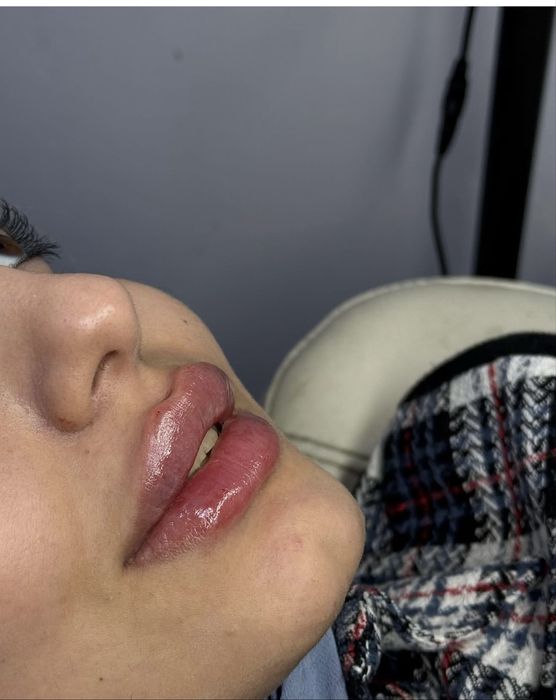 Увеличение губ,мезо,ботокс 30.000