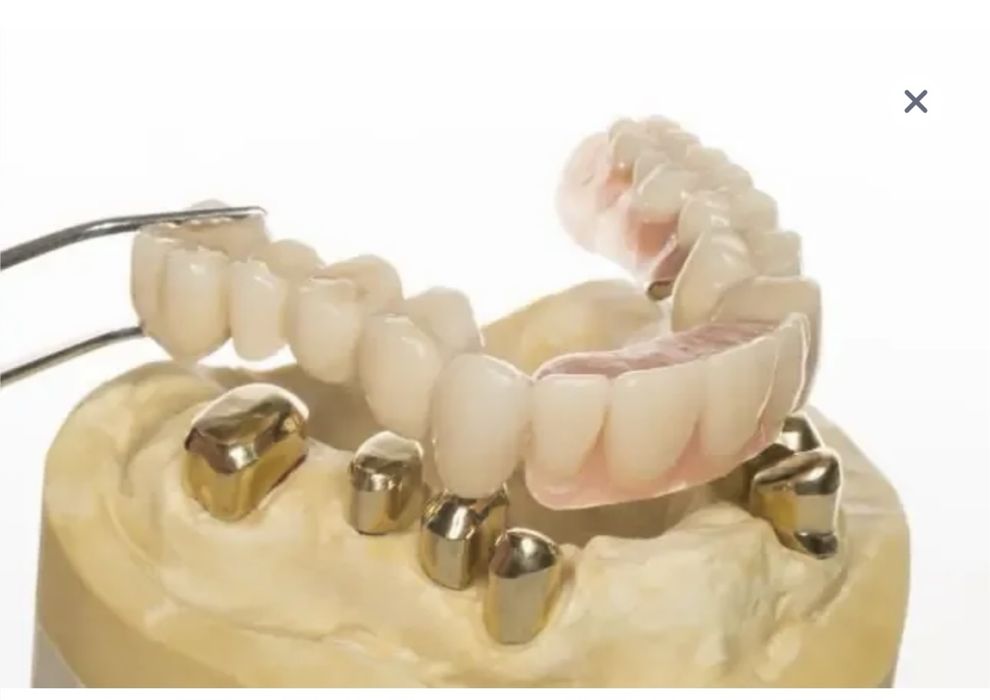 Протезы за самый быстрый срок в городе по доступным ценам