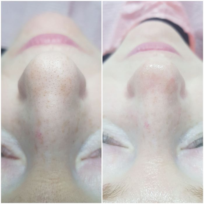 Косметолог.  Чистка лица