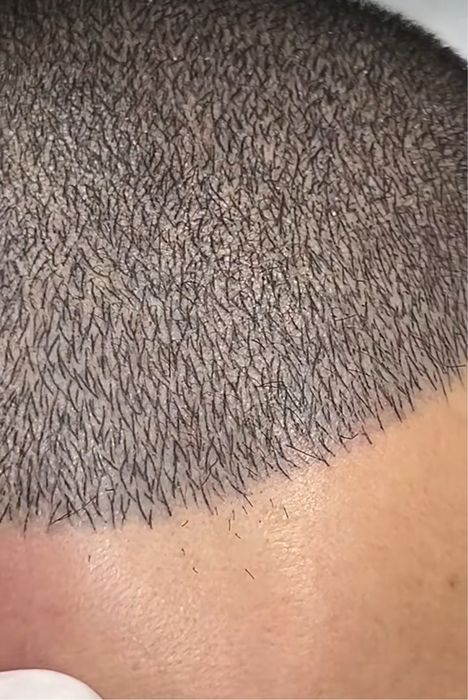Micropigmentare Scalp și barba Bucuresti SMP chelie implant transplant