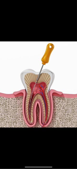 Gratuit tratament dinti