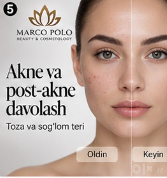 Akne va post-akne uchun kosmetologik parvarish