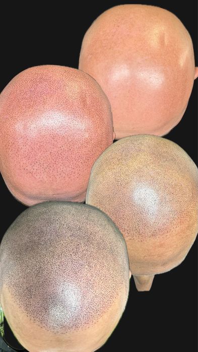Micropigmentare scalp si barba indesire par tatuaj alopecie chelie