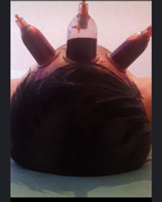 Хиджама процесс обновления и разжижения крови