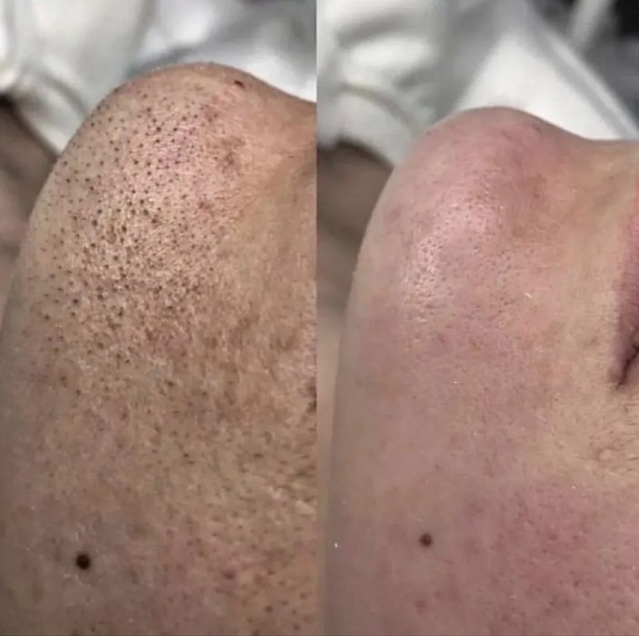 Врач Дерматолог-Косметолог |Чистка лица | Профессиональные процедуры