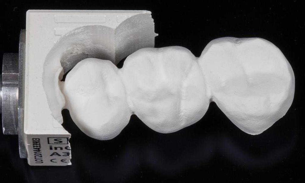 Безметалловая коронка на имплантат (ZrO2) по технологии CAD/CAM