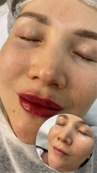 Акция губы, ботокс, чистка, плазма