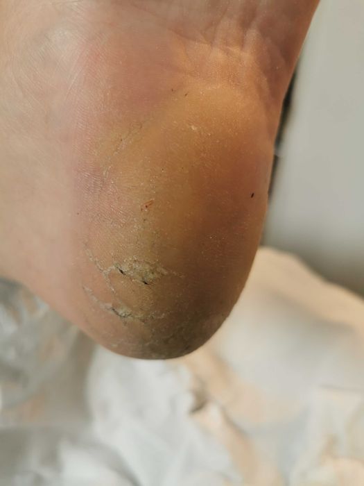 Cabinet pedichiura complexa /onicomicoze /unghii încarnate Alb