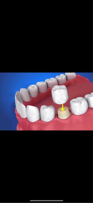Gratuit tratament dinti