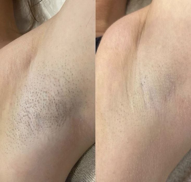 Лазерная эпиляция