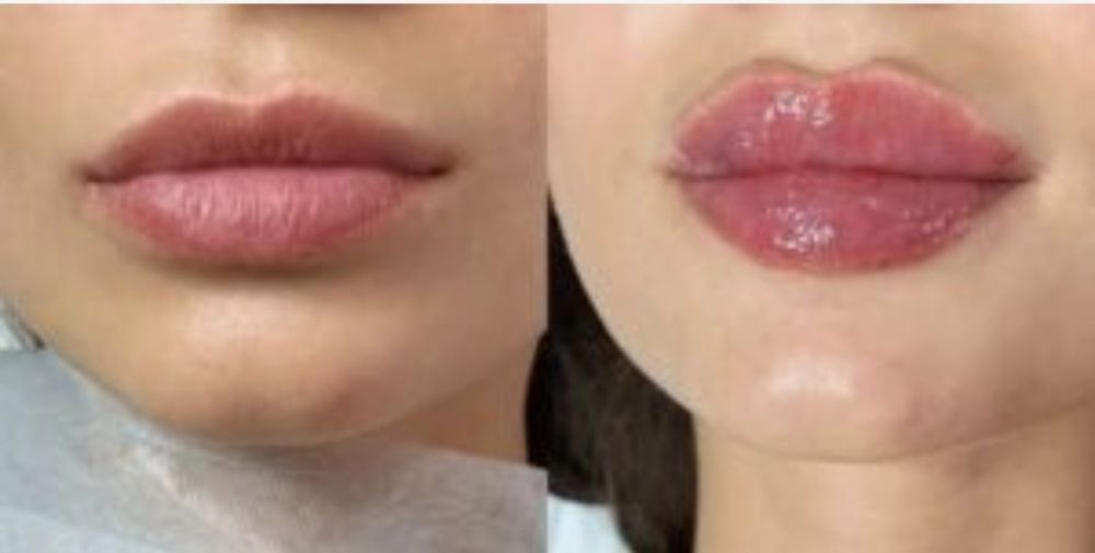 Акция Увелечение губ