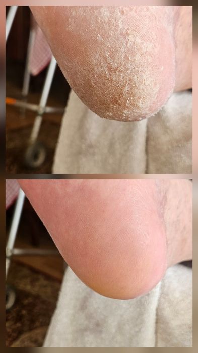 Pedichiură clasică și medicală