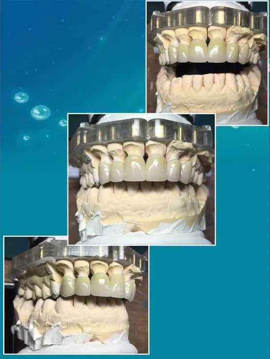 Зуботехническая Лаборатория Cad Cam ht st 4d pmma 3d shtml Протез