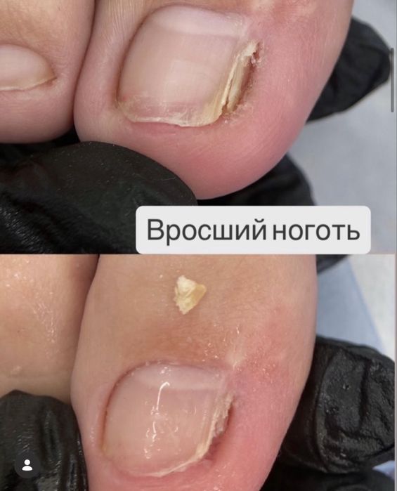 Подолог.Бородавки.Вросший ноготь