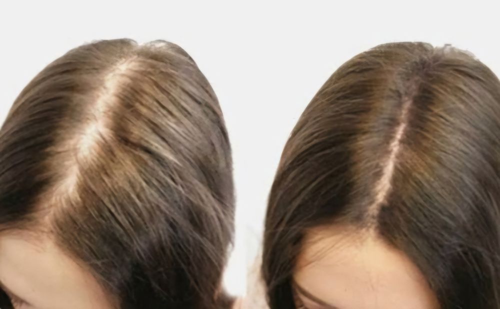 Plazmalifting,yuzga va soch tùkilishiga, Плазмалифтинг