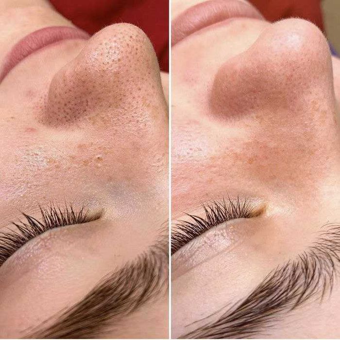 Чистка лица, Yuz tozalash, косметолог.