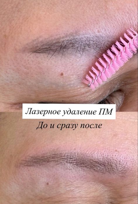 Лазер для удаления татуажа