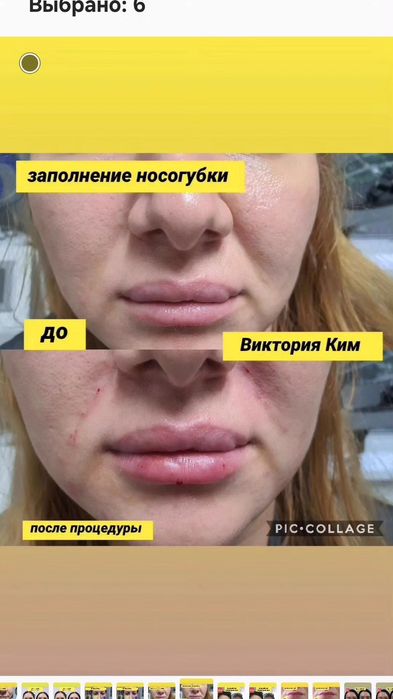 Увеличение губ заполнение носогубки