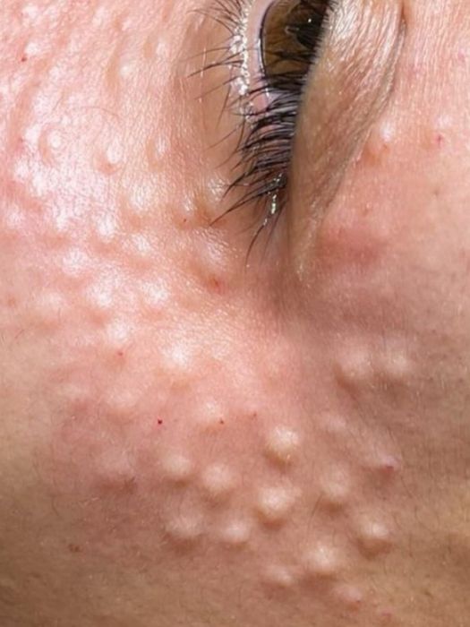 Чистка лица + пилинг 45 квартал