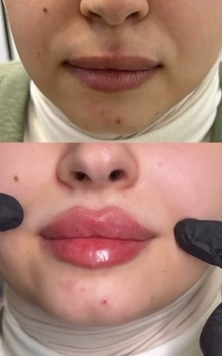 Лазер | Ботокс | Пилинги | Удаление татуажа | Косметолог